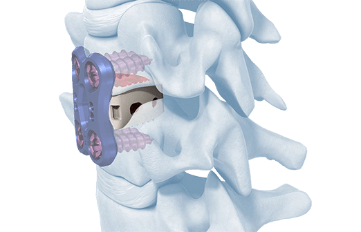Anterior Cervical Inter Body Spacer